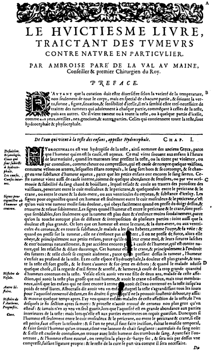 ambroise pare hydrocephalus