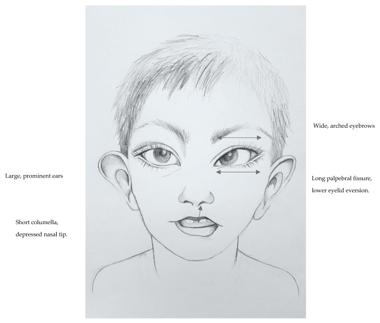 A child exhibiting cardinal Kabuki syndrome facial dysmorphism