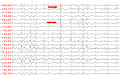 slow spike waves lgs