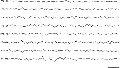 Theta and delta. Patient's age, 4 months. Eyes open. Diffuse mixture of theta and delta. Three to 4 Hz background moderately developed posteriorly. Minimal beta activity, greater right, which waxed and waned on either side in other parts of this recording. Paucity of activity anteriorly. Calibration signal 1 s, 100 µV.