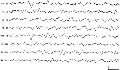 Theta and delta. Patient's age, 4 months. Eyes open. Note increased sensitivity. Mixture of diffuse delta and theta; intermittent 4 Hz background posteriorly. Greater quantity of delta activity in the left posterior head region in this segment was a transient phenomenon occurring intermittently on either side during the recording. Calibration signal 1 s, 70 µV.